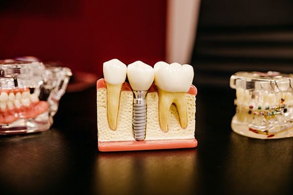 Раскрыт реальный срок службы зубных имплантов