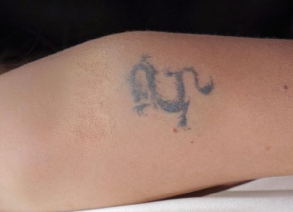 Ничто не вечно: как эффективно удалять татуировки и татуаж?